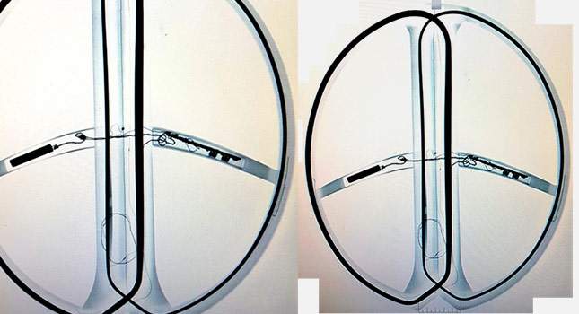 Coils under X-Ray.